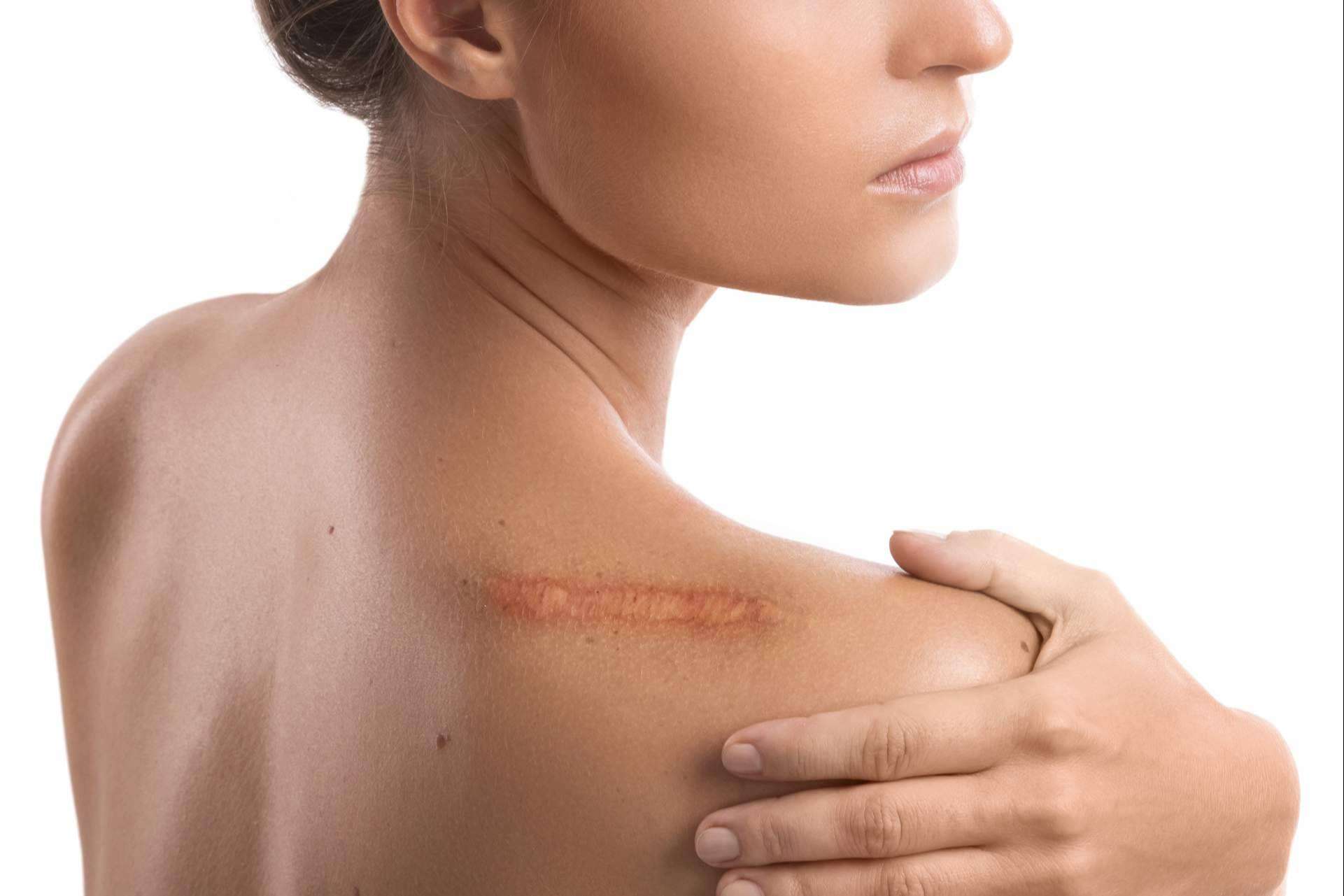 ¿Cómo cuidar las cicatrices en la piel de cara al verano?, por los expertos de La Parafarmacia del Puerto