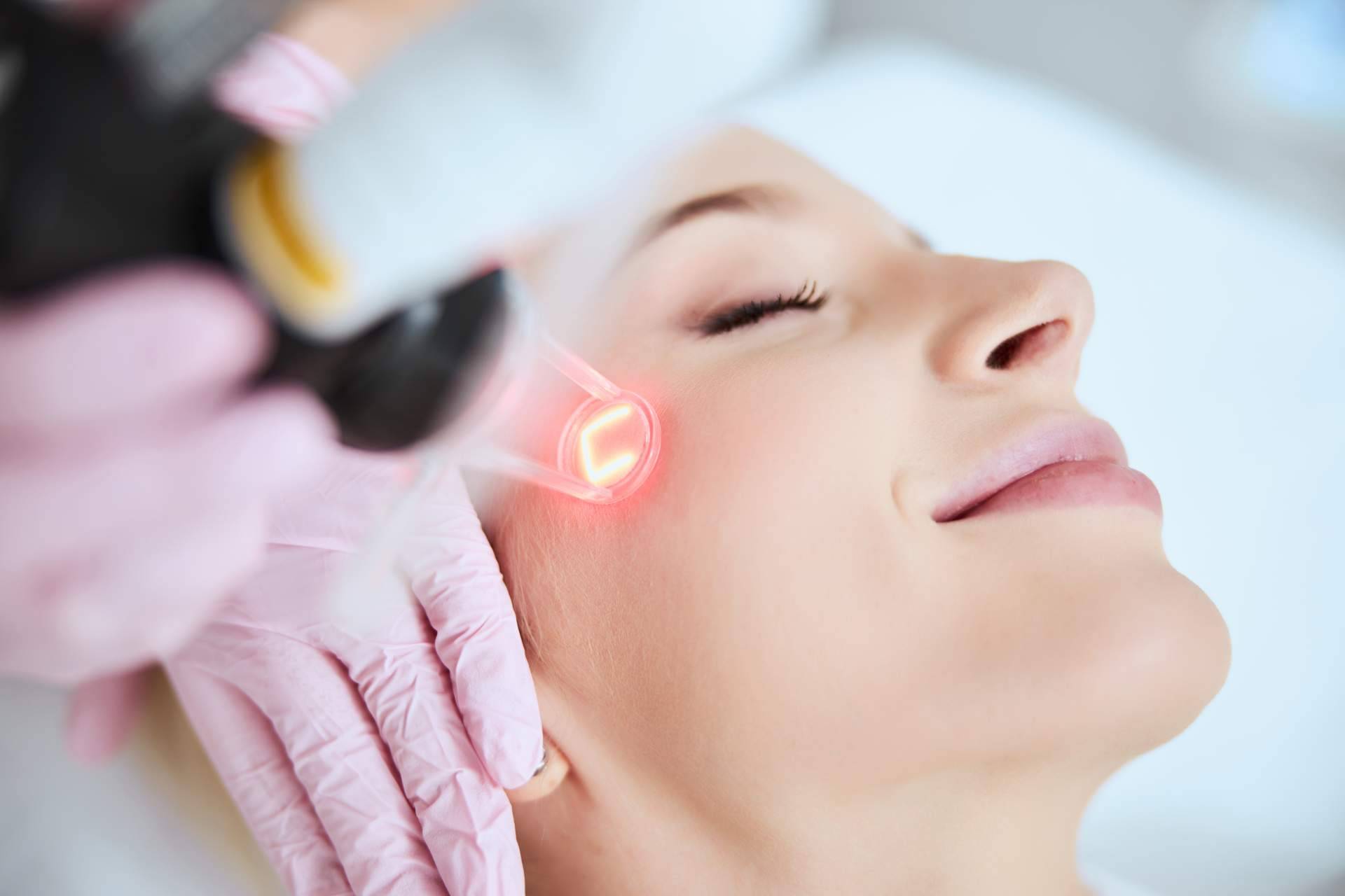 Eliminar marcas de acné con tecnología láser de Centro Estética El Pilar